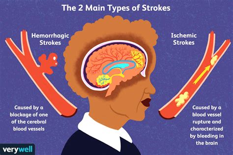 Stroke picture - Showing 787,454 royalty-free vectors for Stroke. The best selection of Royalty Free Stroke Vector Art, Graphics and Stock Illustrations. Download 780,000+ Royalty Free Stroke Vector Images.